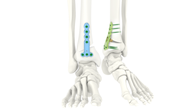 (IMAGE 1) ARIX ANKLE SYSTEM