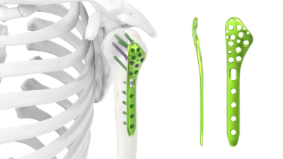 (IMAGE 1) ARIX HUMERUS SYSTEM 3.5 or 4.0 Humerus Plate