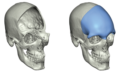 (IMAGE 1) OMNIPORE CRANIAL