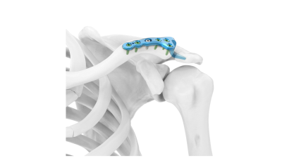 (IMAGE 2) ARIX CLACVICLE SYSTEM