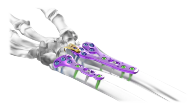 (IMAGE 2) ASTROLABE HAND SYSTEM
