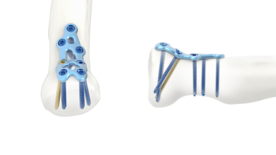 (IMAGE 4) ARIX ELBOW SYSTEM