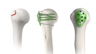 (IMAGE 4) ARIX HUMERUS SYSTEM GT Plate for Avulsion Type