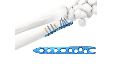 (IMAGE 4) ARIX WRIST SYSTEM (ULNA)