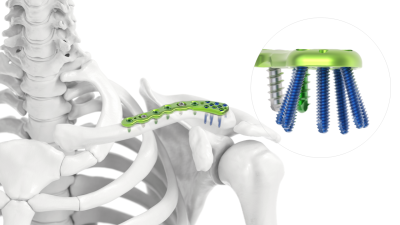 (IMAGE 5) ARIX CLACVICLE SYSTEM Lateral Plate