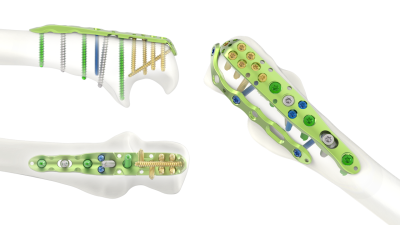 (IMAGE 5) ARIX ELBOW SYSTEM Olecranon Plate