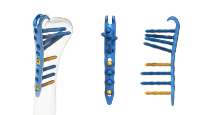 (IMAGE 5) ARIX WRIST SYSTEM (ULNA)