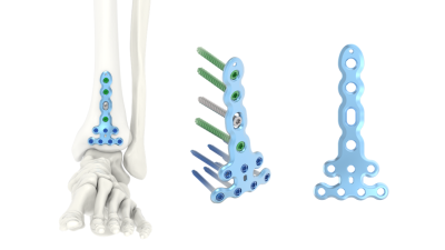 (IMAGE 6) ARIX ANKLE SYSTEM 2.5 or 3.5 Anterior Distal Tibia Plate