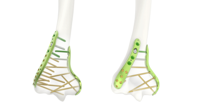 (IMAGE 7) ARIX ELBOW SYSTEM Distal Humerus Plate